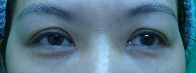桃園 眼袋型黑眼圈 淚溝型黑眼圈 玻尿酸 淚溝 回春 黃政達醫師 醫生 眼袋 041
