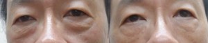 黑眼圈 眼袋 消除 手術 桃園 玻尿酸 眼袋型淚溝  淚溝型黑眼圈  淚溝 黃政達醫師 推薦 208