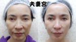 豐頰填玻尿酸、夫妻宮填玻尿酸 化身鵝蛋臉美魔女長效推薦