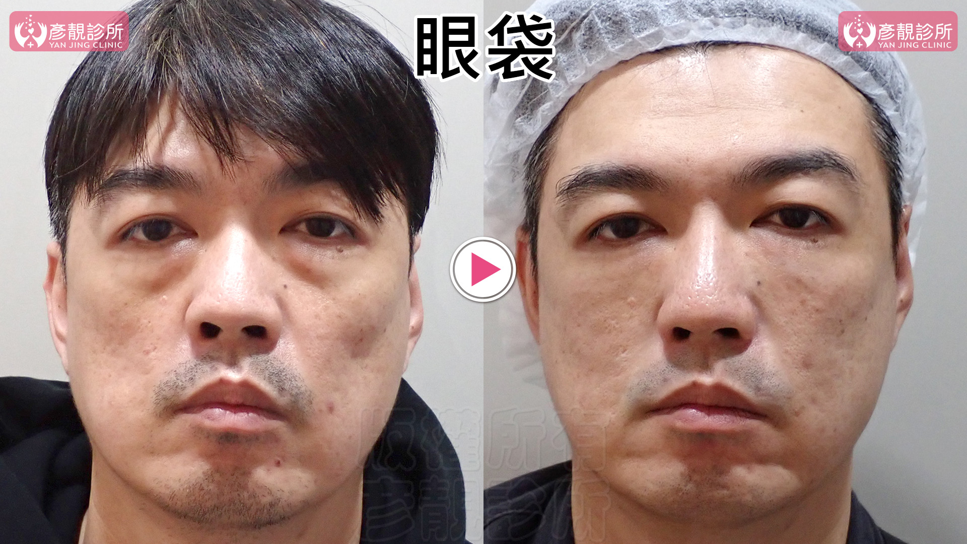 淚溝是黑眼圈的主因:比色素、血管更常見、更好改善 4 眼袋型淚溝正面案例,眼袋隆起與下方淚溝凹陷同時明顯,用來說明淚溝三型是連續的比例表現,並非依年齡或外觀就能硬性歸入固定類別。