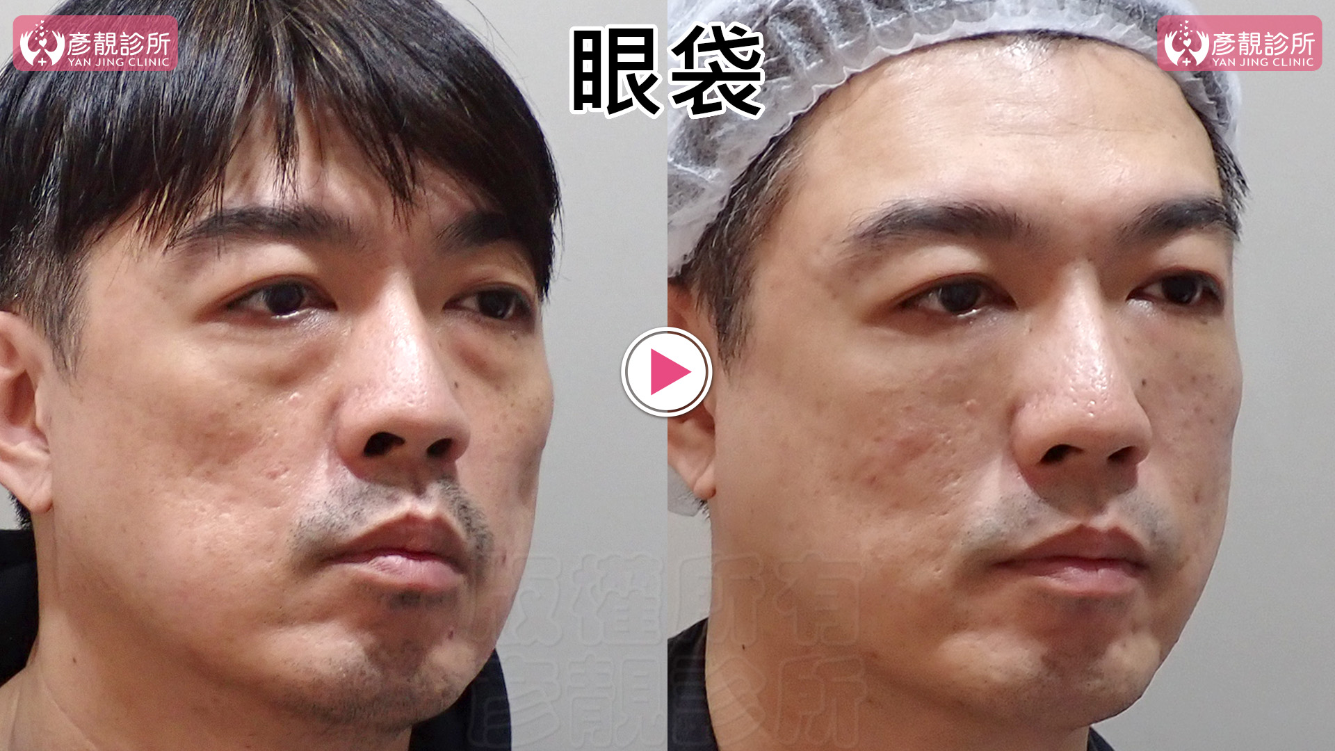 眼袋是什麼?形成原因、玻尿酸與手術怎麼選,效果與費用一次看懂 1 眼袋與淚溝非手術改善案例,左側眼袋膨出及下緣凹陷陰影較明顯,右側眼下轉折較平順;黃政達醫師以 4D 無痕筋膜提升為規劃方向,運用大分子玻尿酸,以支撐和填補同時改善上凸下凹的輪廓。