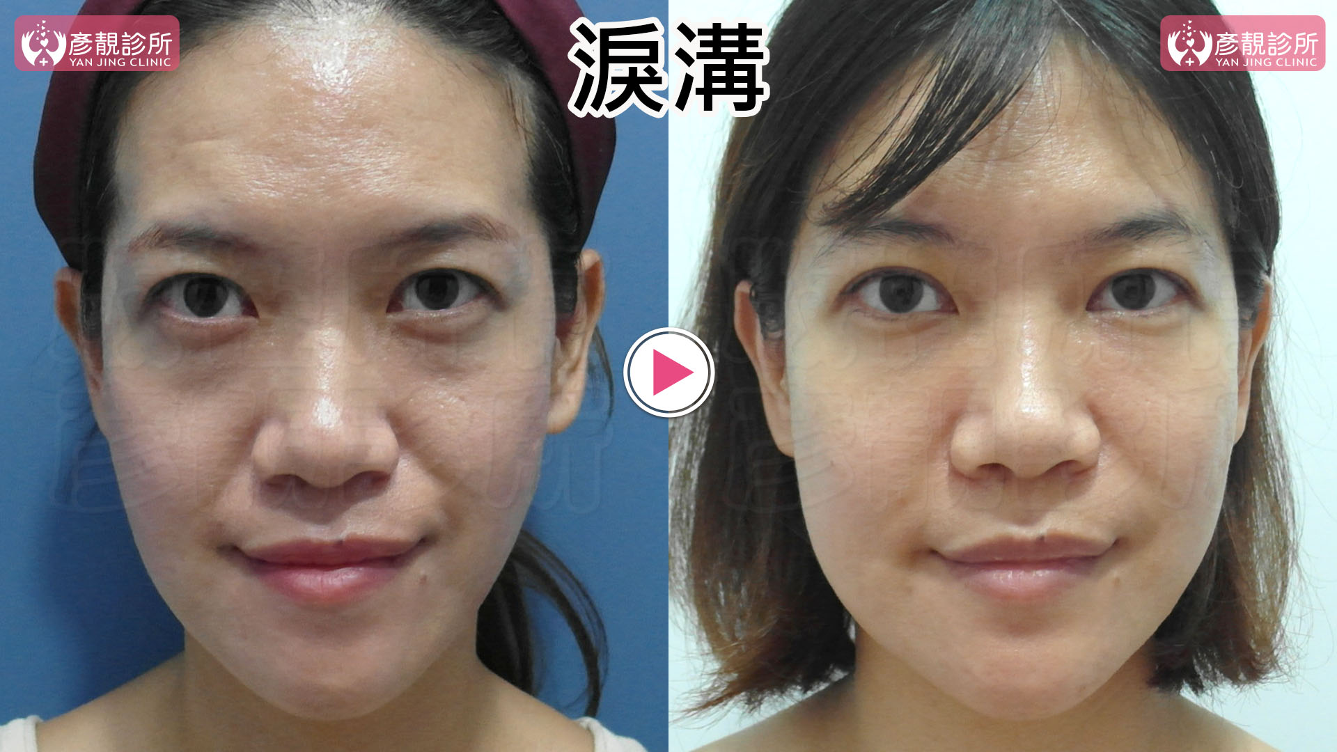 淚溝是黑眼圈的主因:比色素、血管更常見、更好改善 5 女性動態淚溝改善前後正面對照,左側術前在微笑與眼神上看時眼下凹溝較明顯,右側術後表情下的淚溝凹折變淺,眼下至中臉銜接較平順,用來說明動態淚溝需同時觀察放鬆、微笑與瞇眼時的變化。