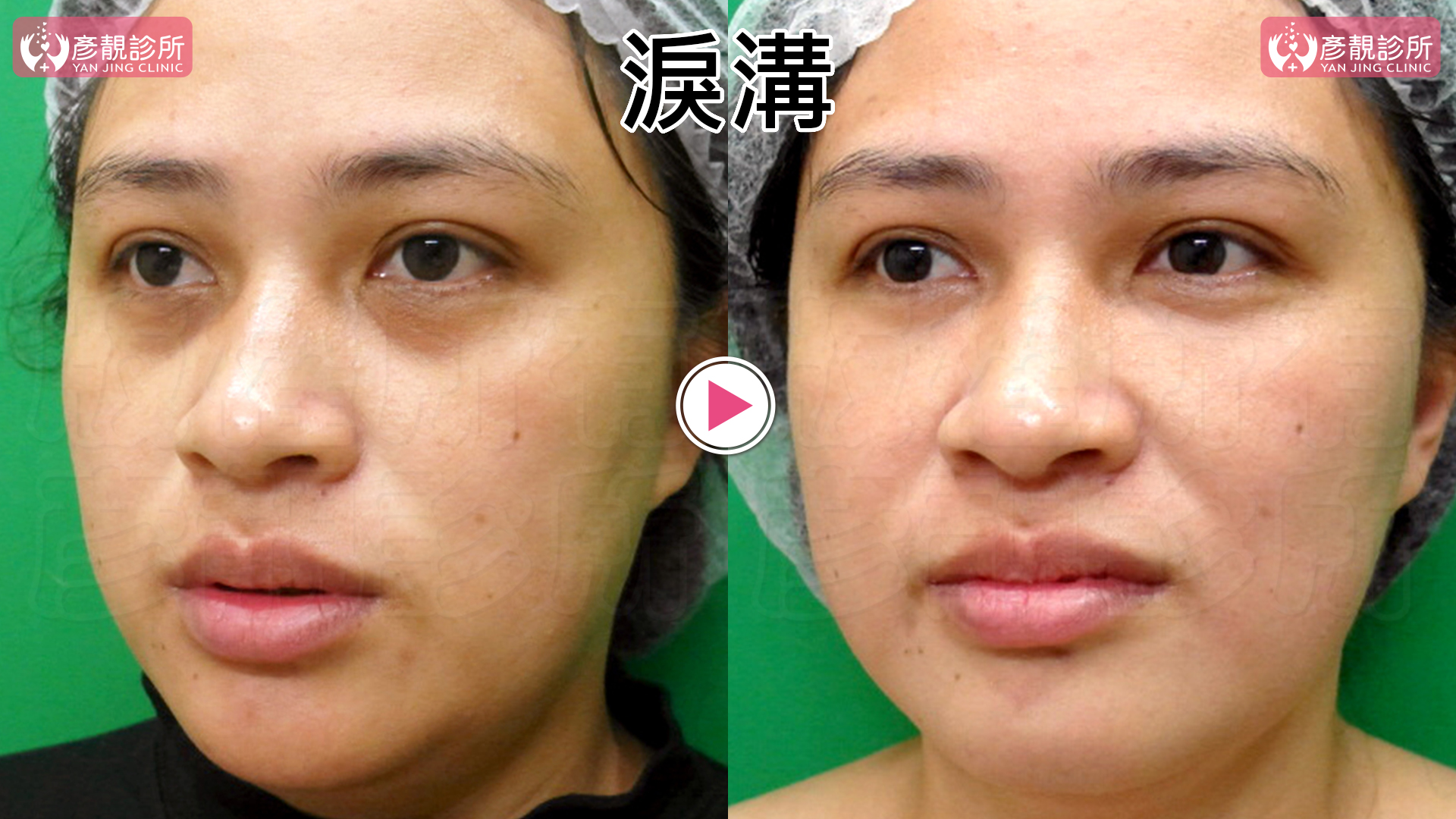 熊貓針是什麼?改善淚溝黑眼圈的效果、維持時間與副作用 1 女性單純型淚溝術前術後對照,左圖從眼頭往下延伸的凹陷與陰影較深,右圖以大分子玻尿酸填補後,眼下到臉頰的落差較柔和,靠近下睫毛的臥蠶起伏仍在,呈現黃政達醫師改善凹影並保留眼周線條的治療方向。