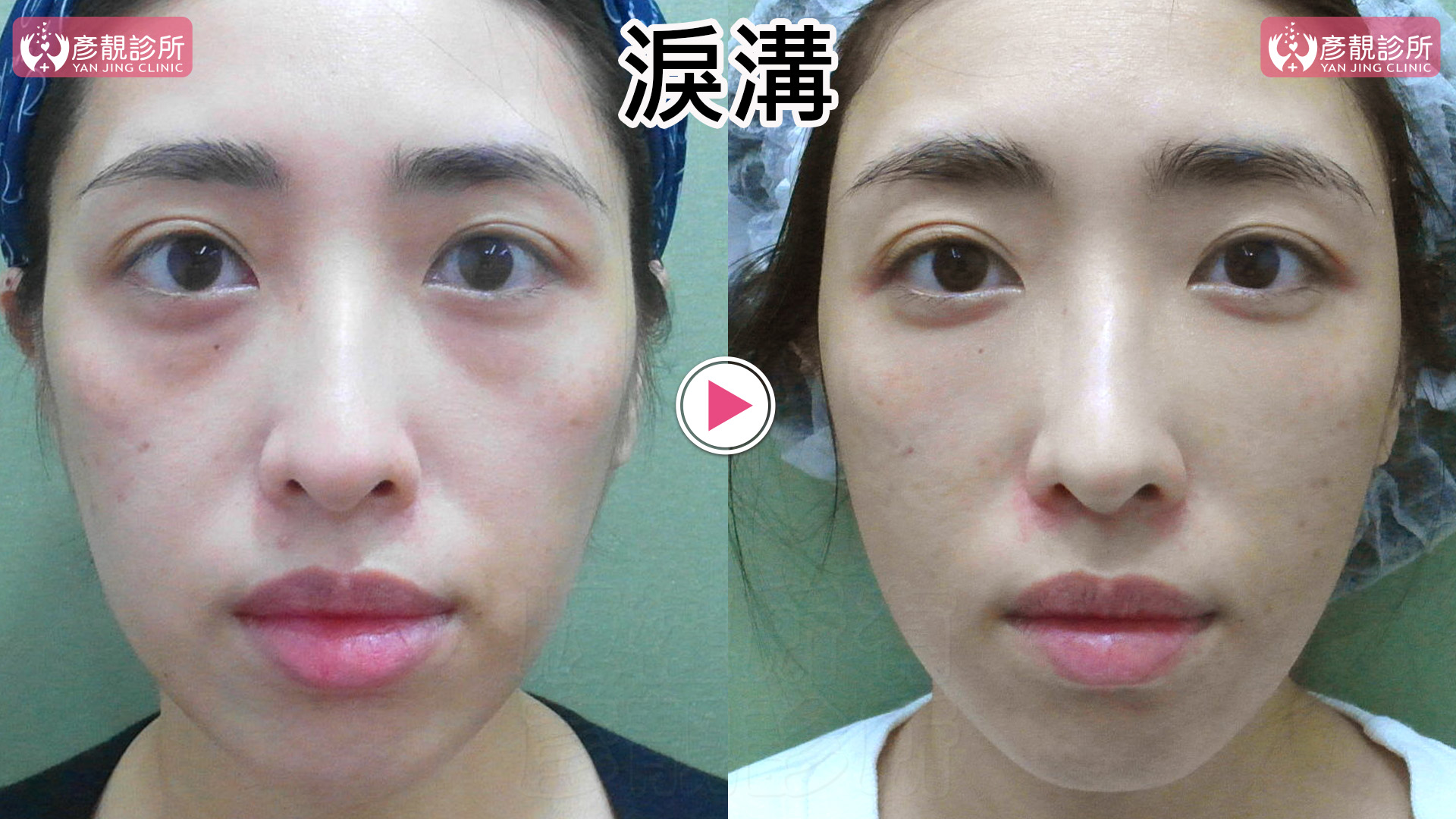 淚溝是黑眼圈的主因:比色素、血管更常見、更好改善 1 淚溝與黑眼圈術前術後正面對照,左側術前眼下淚溝凹陷與結構陰影較明顯,右側術後淚溝陰影變淡,眼下到中臉的銜接較平順,黑眼圈外觀同步減輕,整體精神感與眼神明亮度提升。