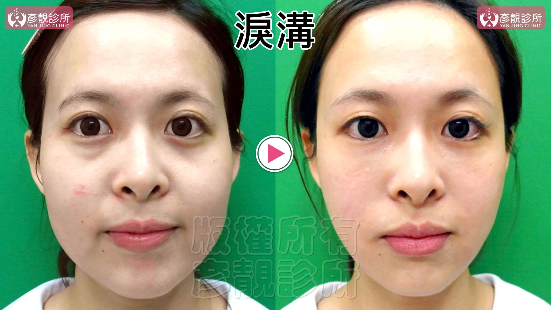 淚溝是黑眼圈的主因:比色素、血管更常見、更好改善 3 淚溝分型正面比較,圖中左眼較接近單純型,以臥蠶下方凹陷為主;右眼較接近溝渠型,可見細長眼袋隆起與下方凹溝,呈現同一張臉兩側可能有不同分型比例。