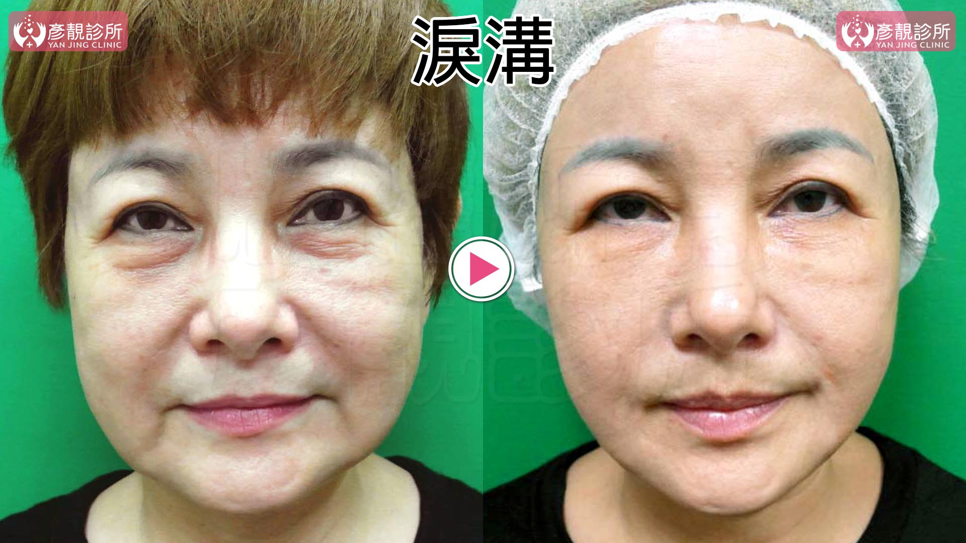 熊貓針是什麼?改善淚溝黑眼圈的效果、維持時間與副作用 5 女性正面術前術後對照,左圖眼袋下緣與臉頰之間有明顯凹溝,右圖以大分子玻尿酸處理後,眼下高低落差較平順、內側凹影減輕,皮膚紋理仍在,呈現黃政達醫師將下方承托與淚溝銜接一起規劃的改善重點。
