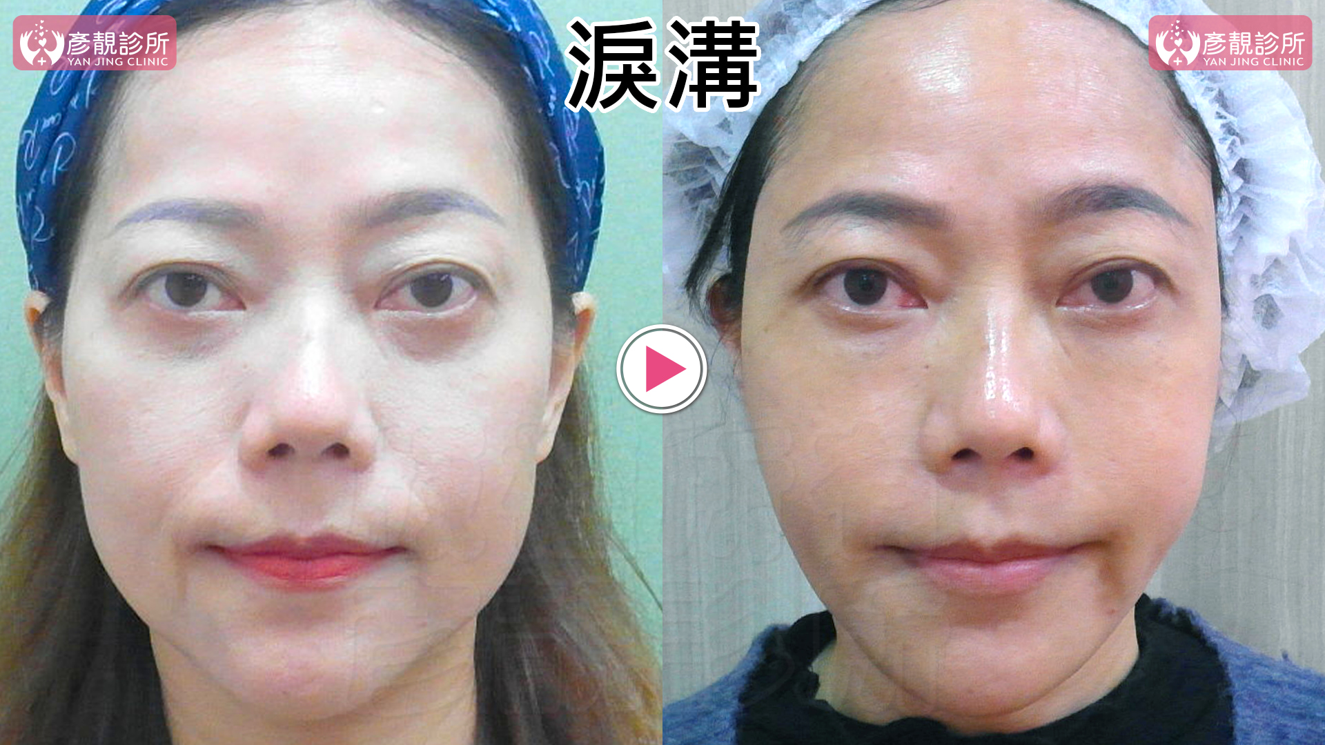 淚溝是黑眼圈的主因:比色素、血管更常見、更好改善 6 淚溝填充前後正面對照,左側術前內側淚溝凹影與眼袋下緣轉折較明顯,右側術後眼下至中臉銜接較平順,同時保留靠近下睫毛的臥蠶與自然眼下層次,呈現深層支點承托而非把所有凹陷補滿的規劃重點。