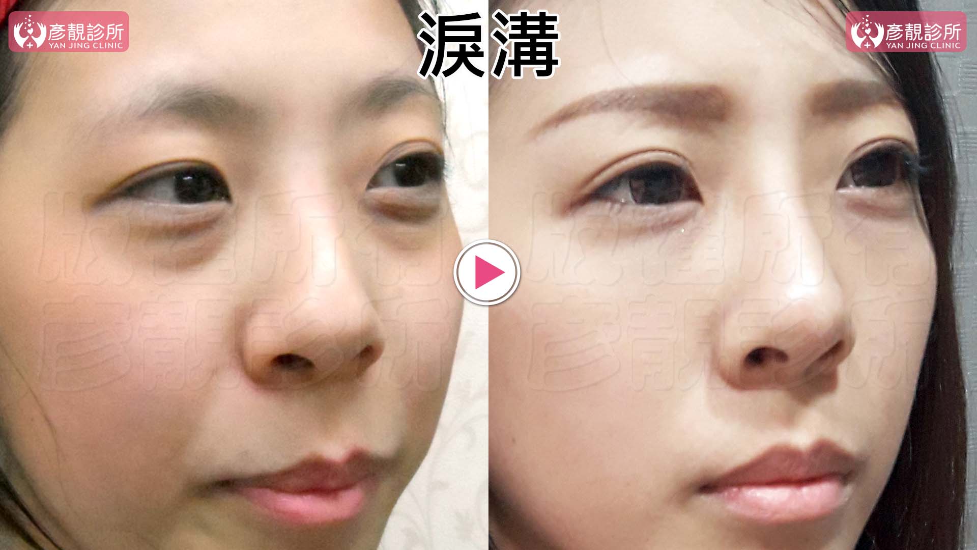 眼袋是什麼?形成原因、玻尿酸與手術怎麼選,效果與費用一次看懂 5 臥蠶、眼袋與淚溝的位置標示,左圖以金黃色實色色塊標示臥蠶、青綠色色塊標示眼袋,均有白色邊框;藍色曲線標示臥蠶下凹痕,紫色曲線沿眼袋下緣標示淚溝,區分兩個隆起及兩道凹線。