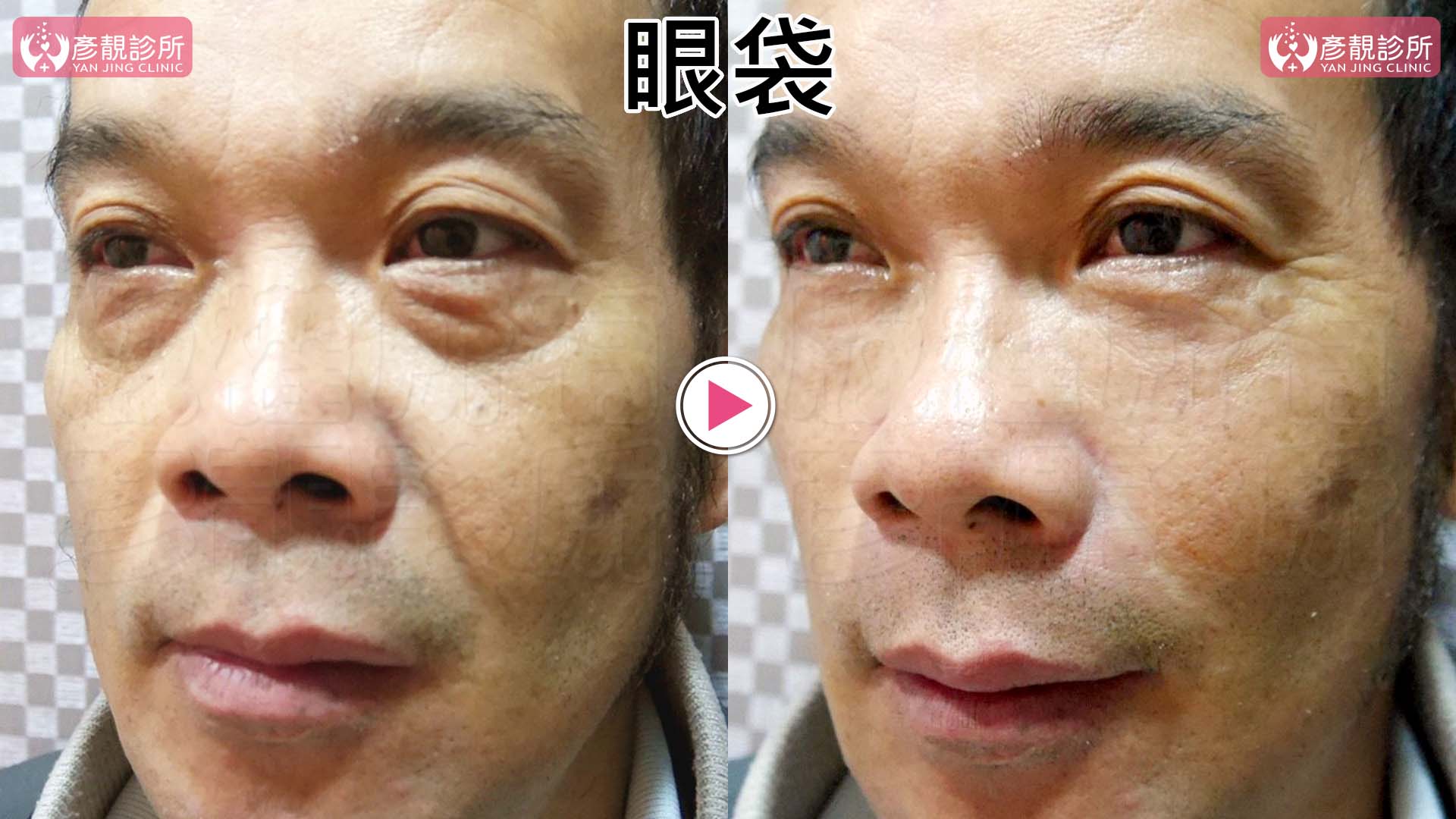 淚溝是黑眼圈的主因:比色素、血管更常見、更好改善 7 眼袋與淚溝非手術支撐規劃的術前術後對照,左側術前眼袋隆起較明顯,右側術後眼下輪廓較平順。