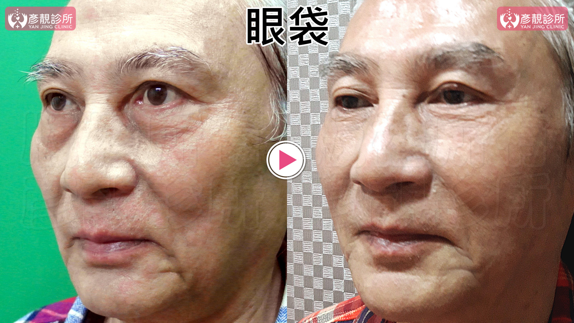 眼袋是什麼?形成原因、玻尿酸與手術怎麼選,效果與費用一次看懂 4 熟齡眼周的眼袋與鬆弛案例,左側眼袋突出、下緣凹溝及陰影較明顯,右側眼下到臉頰的轉折較平順,皮膚細紋仍可見;呈現袋狀膨出、下方凹陷與表層皺紋同時存在時,需要分別辨認的外觀問題。