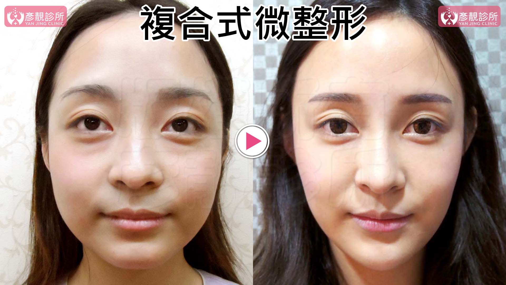 為什麼填充會演變成饅化?饅化如何預防?大量填充也能不饅化 - 黃政達醫師-醫學美容講師醫學網站