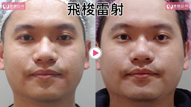 Botox-Anti-Wrinkle Treatment-Wrinkles10101 Botox Anti Wrinkle Treatment Wrinkles10101 1024x576