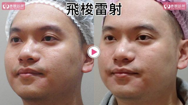 Botox-Anti-Wrinkle Treatment-Wrinkles101010 Botox Anti Wrinkle Treatment Wrinkles101010 1024x576