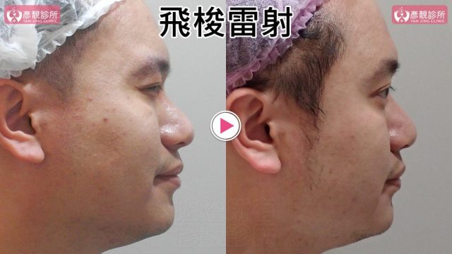 Botox-Anti-Wrinkle Treatment-Wrinkles101011 Botox Anti Wrinkle Treatment Wrinkles101011 1024x576