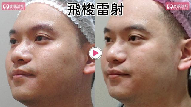 Botox-Anti-Wrinkle Treatment-Wrinkles101012 Botox Anti Wrinkle Treatment Wrinkles101012 1024x576
