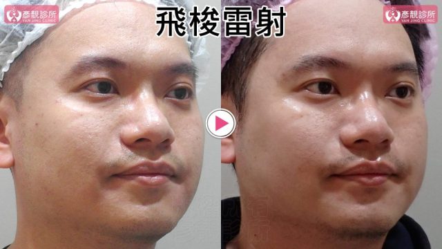 Botox-Anti-Wrinkle Treatment-Wrinkles10102 Botox Anti Wrinkle Treatment Wrinkles10102 1024x576