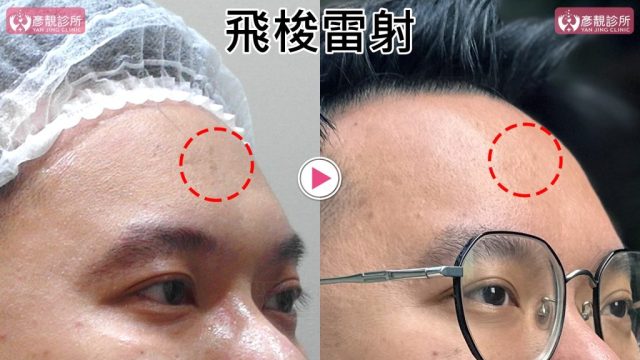 Botox-Anti-Wrinkle Treatment-Wrinkles10103 Botox Anti Wrinkle Treatment Wrinkles10103 1024x576
