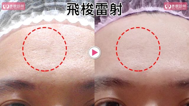 Botox-Anti-Wrinkle Treatment-Wrinkles10104 Botox Anti Wrinkle Treatment Wrinkles10104 1024x576