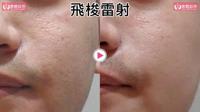 Botox-Anti-Wrinkle Treatment-Wrinkles10105 Botox Anti Wrinkle Treatment Wrinkles10105 1 1024x576