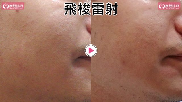 Botox-Anti-Wrinkle Treatment-Wrinkles10106 Botox Anti Wrinkle Treatment Wrinkles10106 1024x576