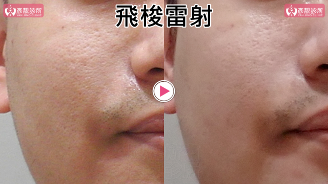 Botox-Anti-Wrinkle Treatment-Wrinkles10107 Botox Anti Wrinkle Treatment Wrinkles10107 1 1024x576