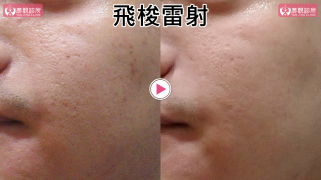 Botox-Anti-Wrinkle Treatment-Wrinkles10108 Botox Anti Wrinkle Treatment Wrinkles10108 1 1024x576