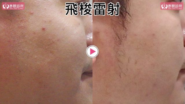 Botox-Anti-Wrinkle Treatment-Wrinkles10109 Botox Anti Wrinkle Treatment Wrinkles10109 1024x576