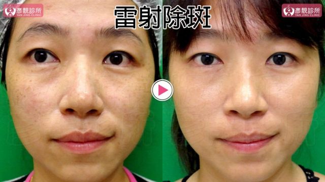Dark Circle Injection-Dark Circles-Cost10101 Dark Circle Injection Dark Circles Cost10101 1024x576