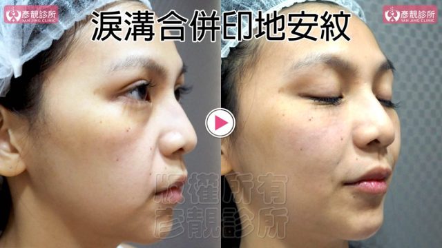 Hyaluronic Acid Marionette Lines Price 10021 1 1024x576