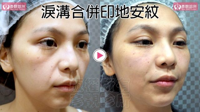 Hyaluronic Acid Marionette Lines Price 10022 1 1024x576