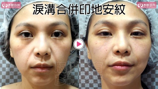 Hyaluronic Acid Marionette Lines Price 10023 1 1024x576