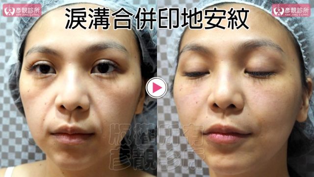 Hyaluronic Acid Marionette Lines Price 10024 1 1024x576