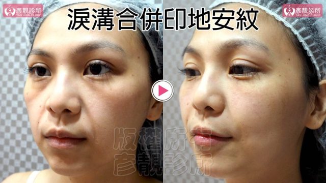 Hyaluronic Acid Marionette Lines Price 10025 1 1024x576