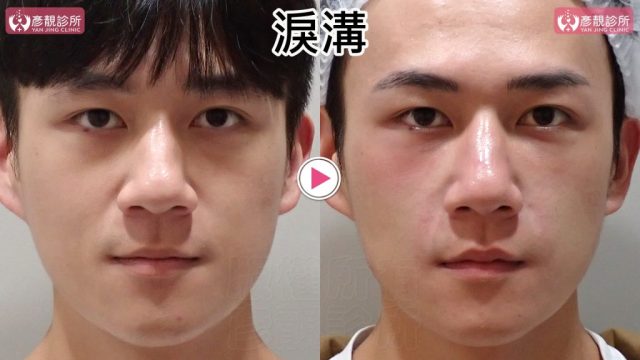 Hyaluronic Acid Nasolabial Folds Before and After 09301 1024x576