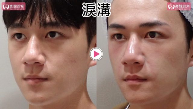 Hyaluronic Acid Nasolabial Folds Before and After 09302 1024x576