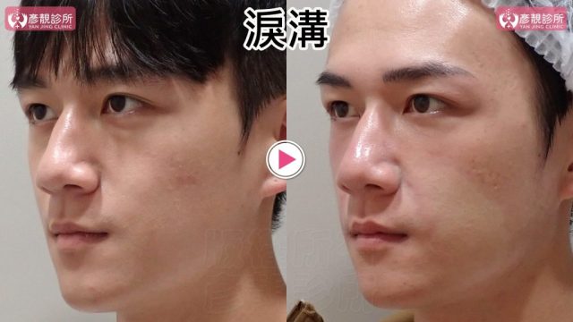Hyaluronic Acid Nasolabial Folds Before and After 09303 1024x576