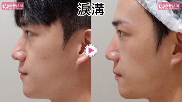 Hyaluronic Acid Nasolabial Folds Before and After 09304 1024x576