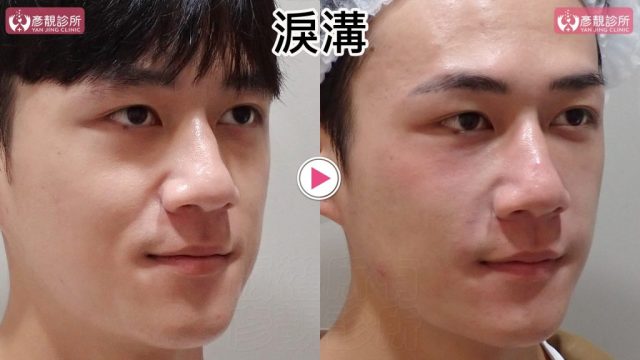 Hyaluronic Acid Nasolabial Folds Before and After 09305 1024x576