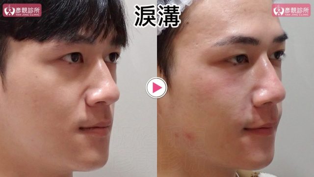 Hyaluronic Acid Nasolabial Folds Before and After 09306 1024x576