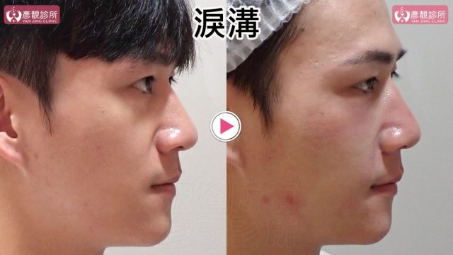 Hyaluronic Acid Nasolabial Folds Before and After 09307 1024x576