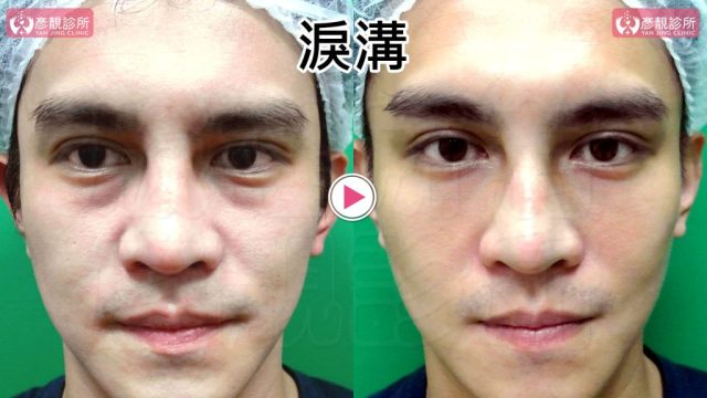 Hyaluronic Acid Tear Trough Under Eye Bags 09302 1 1024x576