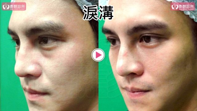 Hyaluronic Acid Tear Trough Under Eye Bags 09303 1 1024x576