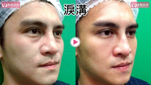 Hyaluronic Acid Tear Trough Under Eye Bags 09304 1 1024x576