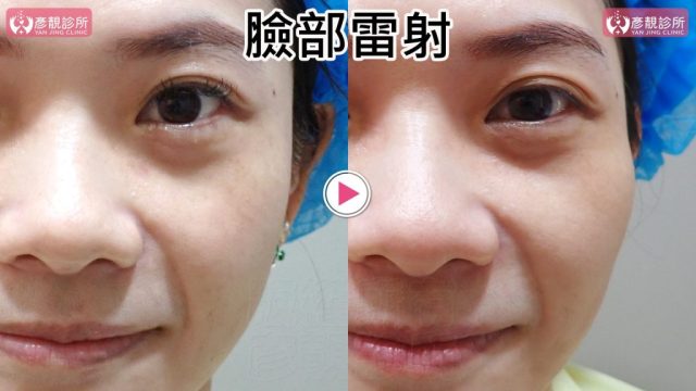 Hyaluronic Acid-Tear Trough-Under Eye Bags10101 Hyaluronic Acid Tear Trough Under Eye Bags10101 1024x576