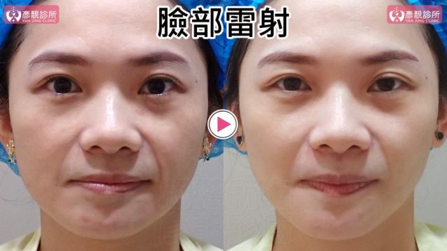 Hyaluronic Acid-Tear Trough-Under Eye Bags10102 Hyaluronic Acid Tear Trough Under Eye Bags10102 1024x576