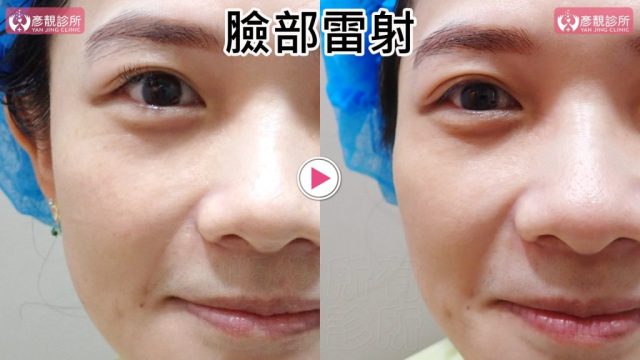 Hyaluronic Acid-Tear Trough-Under Eye Bags10103 Hyaluronic Acid Tear Trough Under Eye Bags10103 1024x576