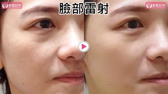 Hyaluronic Acid-Tear Trough-Under Eye Bags10104 Hyaluronic Acid Tear Trough Under Eye Bags10104 1024x576