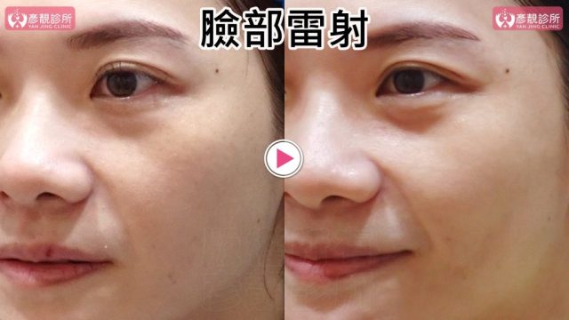 Hyaluronic Acid-Tear Trough-Under Eye Bags10105 Hyaluronic Acid Tear Trough Under Eye Bags10105 1024x576