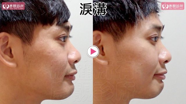 Marionette Lines Nasolabial Folds Hyaluronic Acid 09301 1024x576