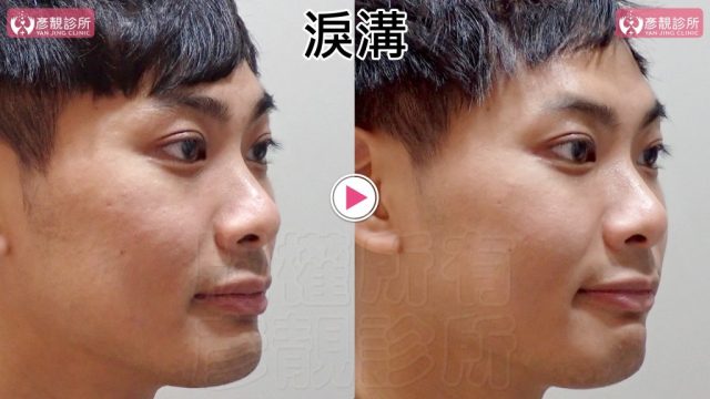 Marionette Lines Nasolabial Folds Hyaluronic Acid 093017 1024x576